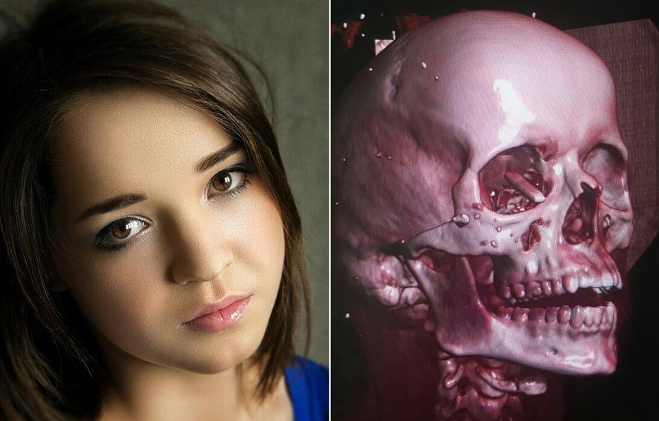 Fotomodelin gözünə qəzada 8 sm-lik şüşə batdı -  Həkimlər xilas etdi/ FOTO