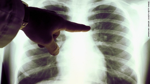 Ağciyər xərçəngində yeni radioterapiya –  Uzman onkoloqdan açıqlama- VİDEO