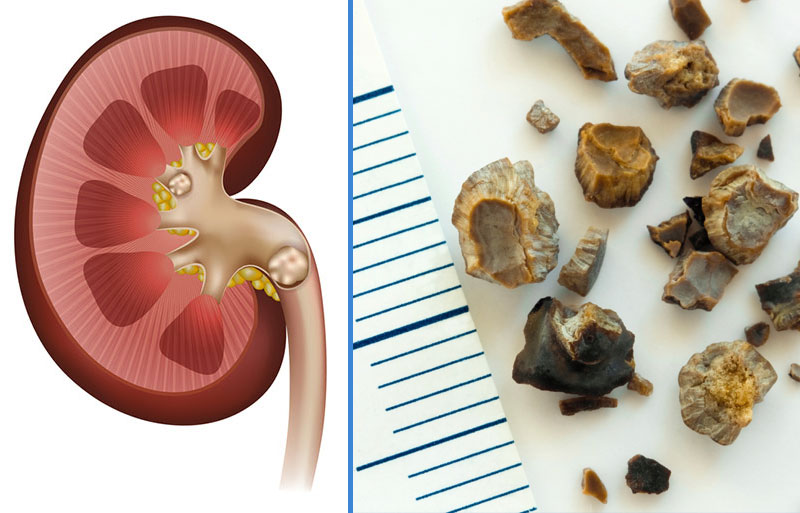 Böyrək və öd kisəsi daşlarından təbii yolla azad olun -  Qəpik-quruşluq reseptlər