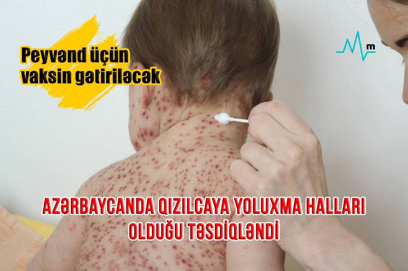 Azərbaycanda qızılcaya yoluxma halları olduğu təsdiqləndi -  Peyvənd üçün vaksin gətiriləcək/ RƏSMİ 