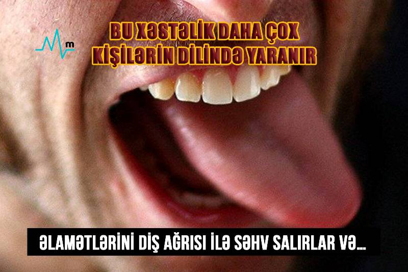 Bu xəstəlik daha çox kişilərin dilində yaranır -  Əlamətlərini diş ağrısı ilə səhv salırlar və…