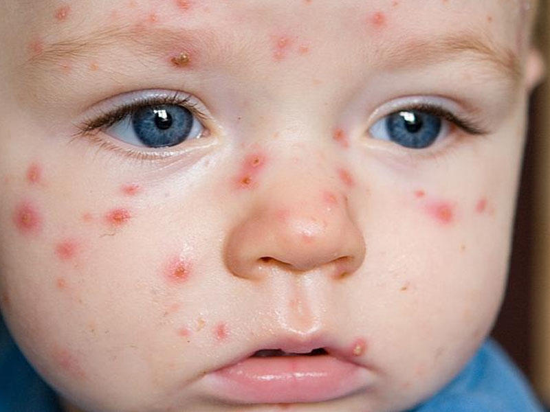 Gürcüstan qızılca epidemiyası təhlükəsi ilə üz-üzə 