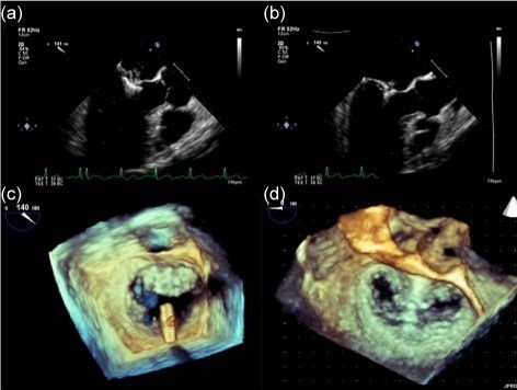 Ürəkdə mitral qapaq çatışmazlığı nədir? –  Revmatizmalı xəstələr risk altındadır