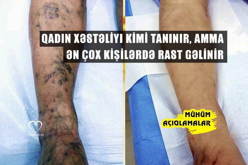 Qadın xəstəliyi kimi tanınır, amma ən çox kişilərdə rast gəlinir -  Mütəxəssisdən mühüm açıqlamalar