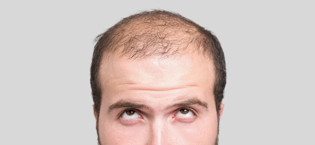 Saçı çox tökülən kişilər bu xəstəlikləri yoxlatsınlar -  Dazlaşmanın səbəbləri