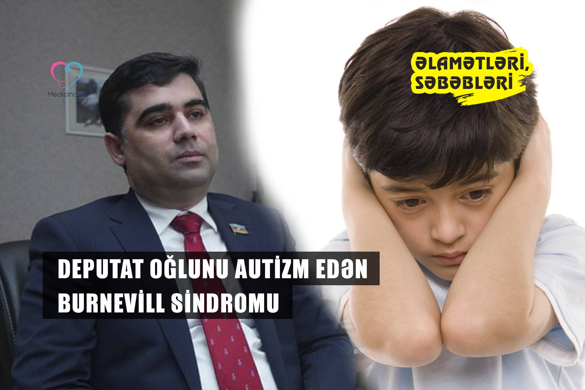 Deputat oğlunu autizm edən Burnevill sindromu -  Müalicəsi yoxdur