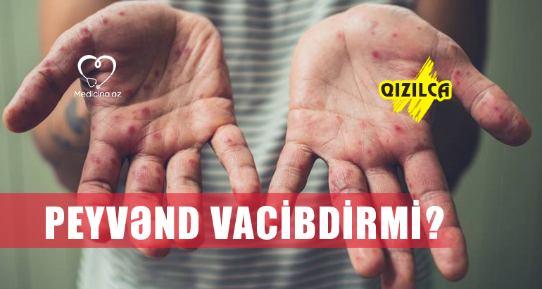 peyvənd vacibdirmi?  Qızılca: 