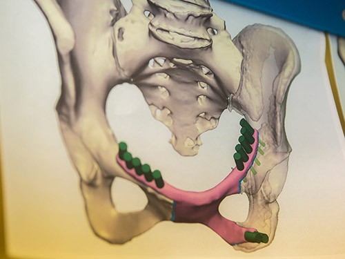 Qadına 3 D printerdə hazırlanmış çanaq sümüyü köçürüldü –  TİBDƏ ilk