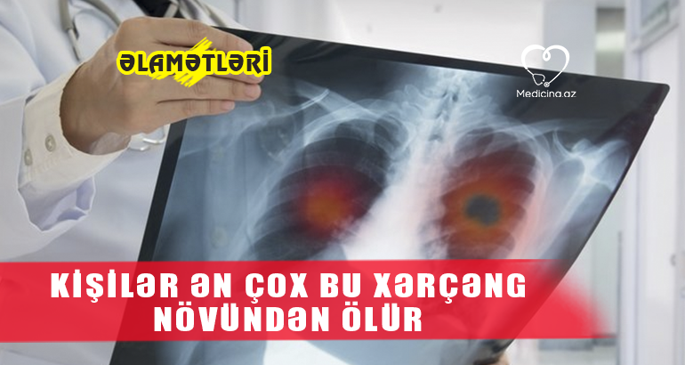 Kişilər ən çox bu xərçəng növündən ölür  – ƏLAMƏTLƏRİ