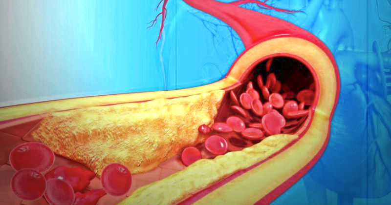 Qanı şəkər, lipid və xolesterindən təmizləyən vasitə -  Damarlarınız güzgü kimi olacaq