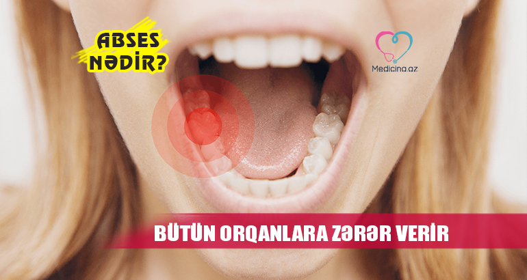 Abses nədir?  – BÜTÜN ORQANLARA ZƏRƏR VERİR 