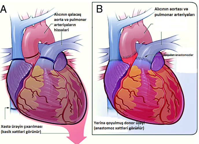  “Azərbaycanda ürək transplantasiyası həyata keçiriləcək"  - Bakıda kardioloqların 40 illiyi 