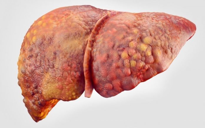 Sirrozu təkcə hepatit yaratmır, başqa səbəblər də çoxdur –  Müayinə barədə həkim məsləhəti