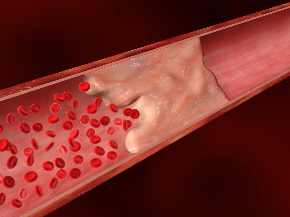 Damar tıxanmasını da antibiotiklə müalicə edəcəklər –  ALİMLƏR