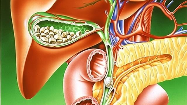 Xroniki daşsız xolesistit nədir? -  Həkim səbəb və müalicəsini AÇIQLADI