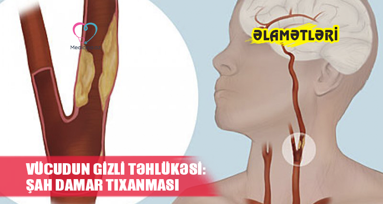 Vücudun gizli təhlükəsi:  ŞAH DAMAR TIXANMASI – Əlamətləri