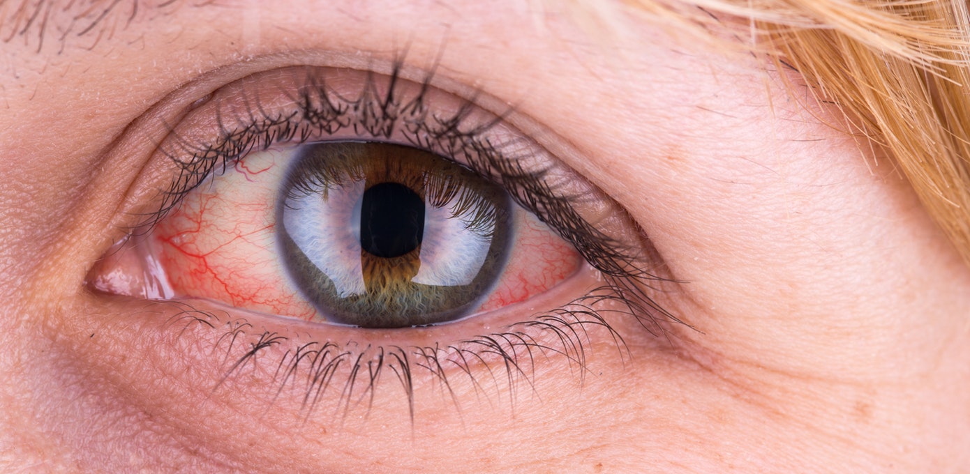 Göz qızartısının səbəbi nədir?  – BU XƏSTƏLİKLƏRİN XƏBƏRÇİSİDİR