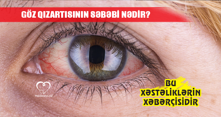 Göz qızartısının səbəbi nədir?  – BU XƏSTƏLİKLƏRİN XƏBƏRÇİSİDİR