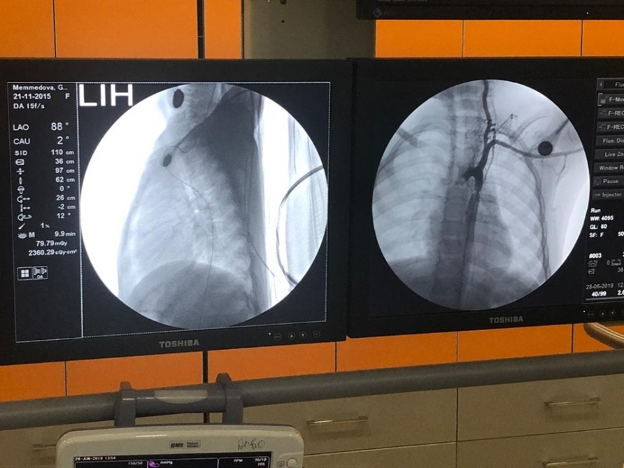 4 yaşlı uşağın ürəyində aorta koartasiyasının darlığı aradan qaldırıldı 