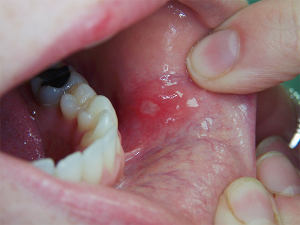 Dünyada ağız boşluğu xəstəlikləri yayılır –  Dodaq və dil xərçəngi riski