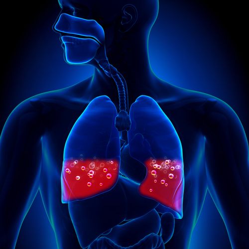 Ürək astması –  İnsanı bir anda öldürə bilən xəstəliyin səbəbləri, əlamətləri