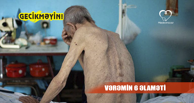 Vərəmin 6 əlaməti –  Gecikməyin!