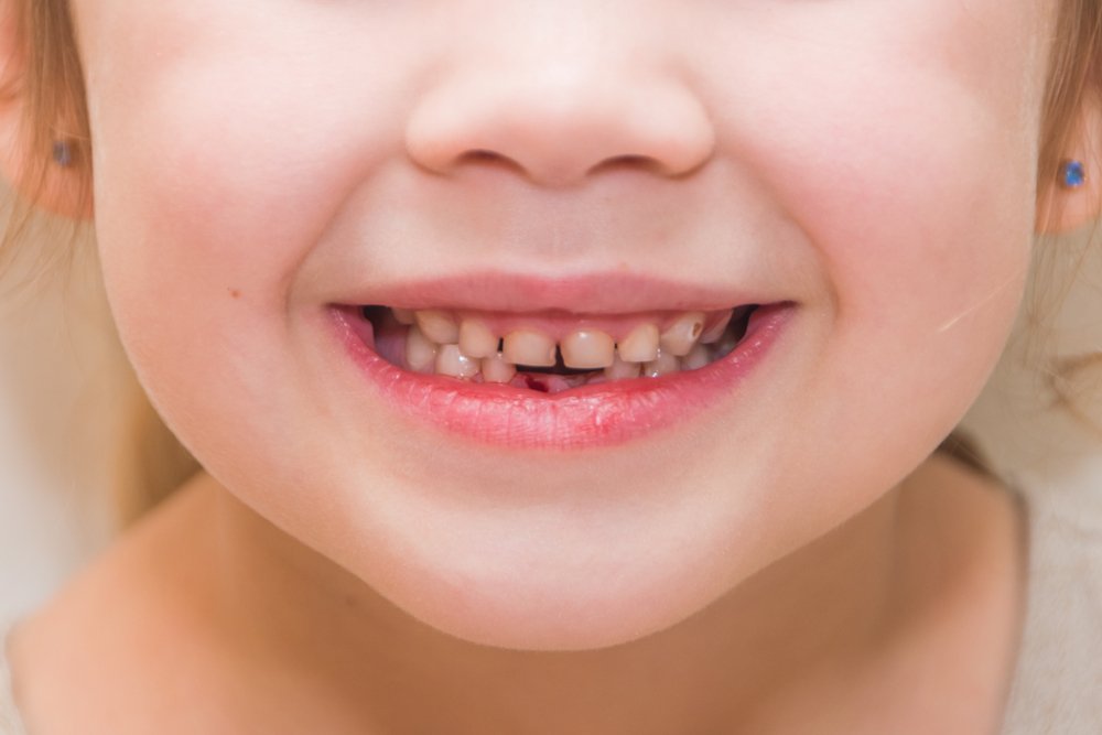Süd dişlərində çürük yaranmasının əsas səbəbləri  