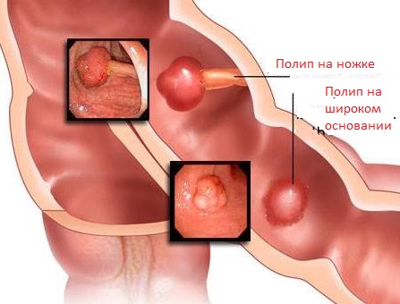 Polip nədir, xərçəngə çevrilirmi? –  Əməliyyat, yoxsa müalicə?