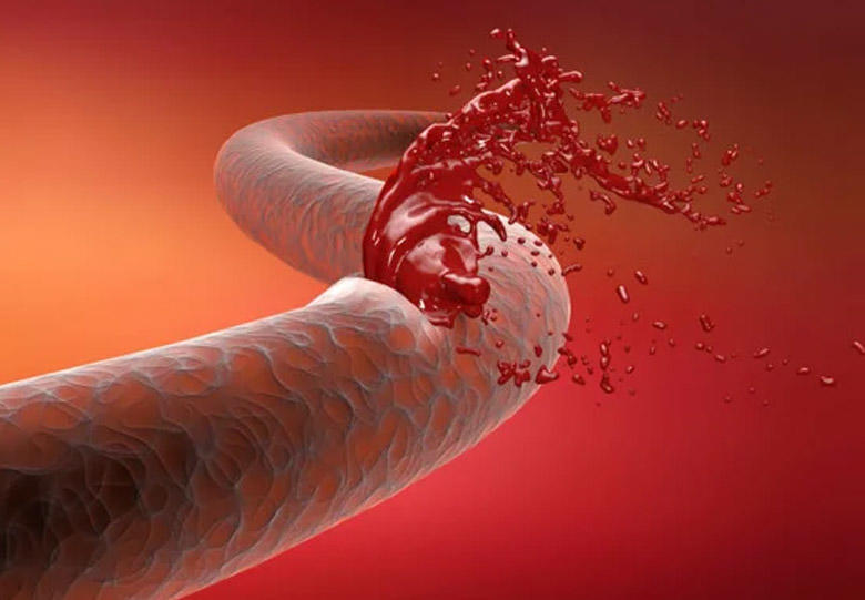 Arterial qanaxmanı dayandıran hidrogel hazırlanıb 