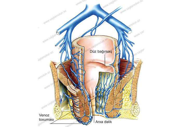Babasil xəstəliyi  - hemorroy 