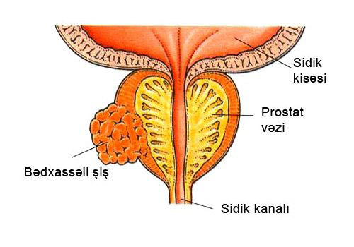 Prostat xərçəngi –  Bütün kişilər risk altında...