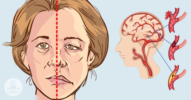 İnsultdan qorunmaq üçün nə edə bilərsən? –  7 METOD