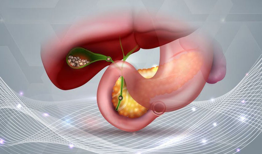 Öd kisəsi çıxarıldıqdan sonrakı həyat–  Əməl olunmalı 3 qayda