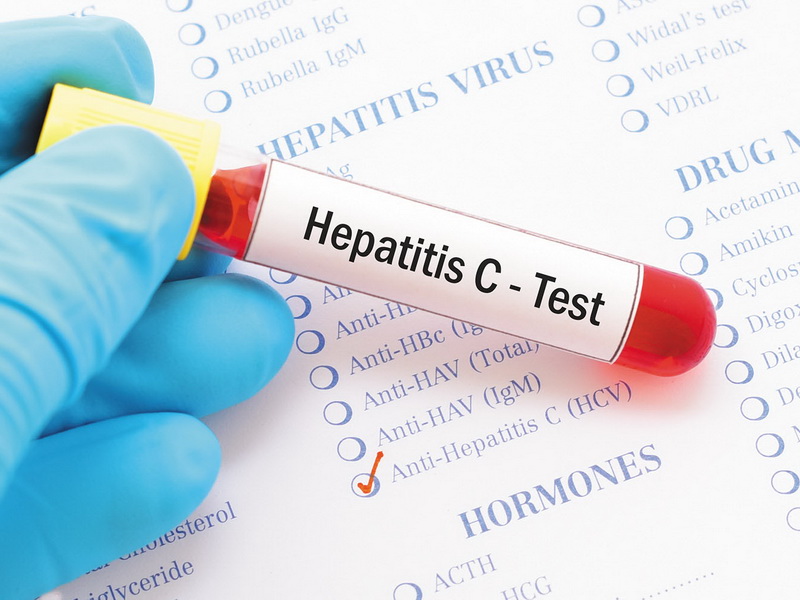 Hepatit C, B və D Virusları -  Ən dəqiq analizləri harda, necə verməli? 