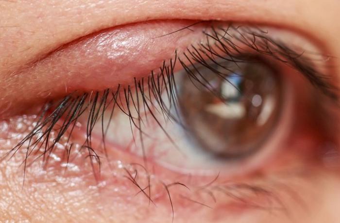 Soyuq aylarda gözlərdə yaranan problemlər: allergiya, sulanma, göz xərçənginin səbəbləri–  Uzman oftalmoloqla MÜSAHİBƏ