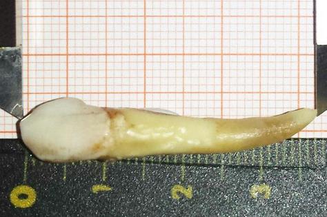 Stomatologiya tarixində xəstədən ən uzun diş çıxarıldı –  3,7 sm-lik rekord