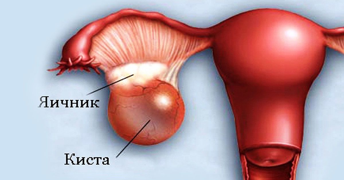 Yumurtalığın follikulyar kistası-  Yaranma səbəbi, müalicəsi