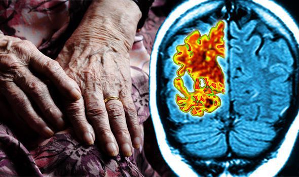 Demensiyanın səbəbi beynin iltihabıdır –  Yeni iddia