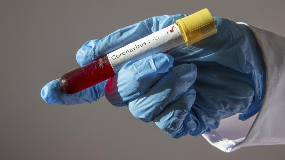 SON DƏQİQƏ -  Daha iki azərbaycanlıda koronavirus aşkarlandı 