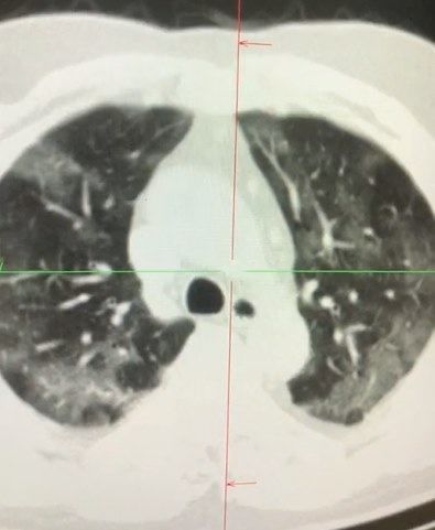 Koronavirus Azərbaycanda qadının ağciyərlərini bu hala saldı - FOTO