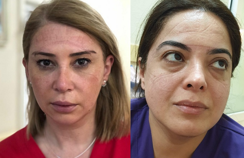 Virusla mübarizə aparan həkimlər:   “Burda cəhənnəm əzabı çəkirlər...” - FOTOLAR