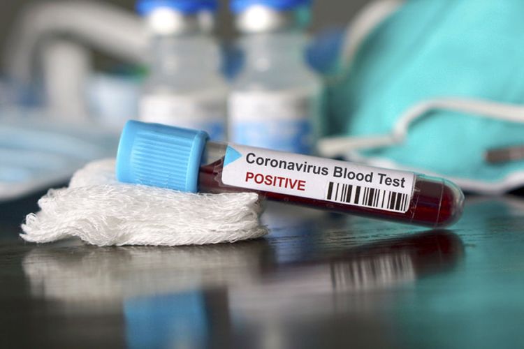 Gürcüstanda 9 nəfər koronavirusdan öldü  