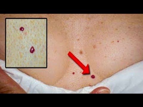 Bədəndə yaranan qırmızı nöqtələr - SƏBƏBİ