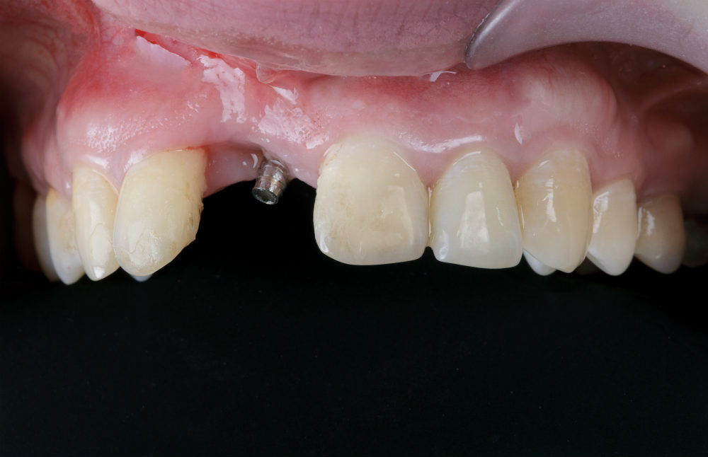 Kimlərə implant diş əkdirmək olmaz?   – Qadağa siyahısı
