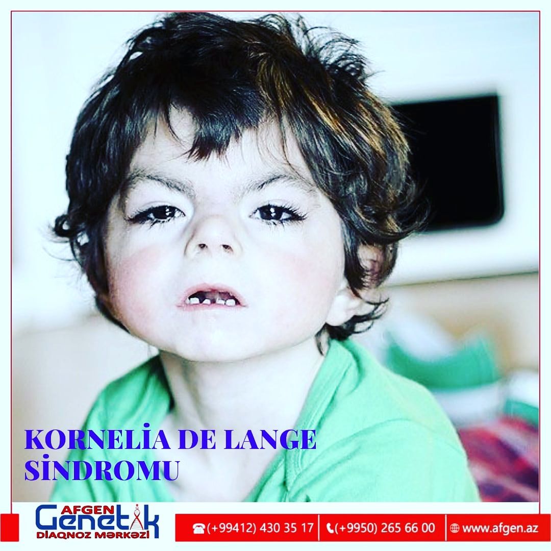 Azərbaycanda da rast gəlinən genetik xəstəlik    Kornelia De Lange sindromu