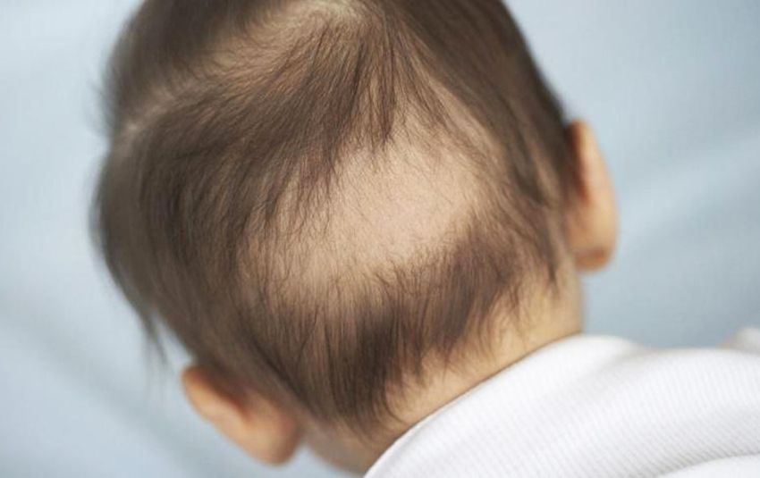 Uşaqlarda saç tökülməsinin əlamətləri -  Pediatr açıqladı 