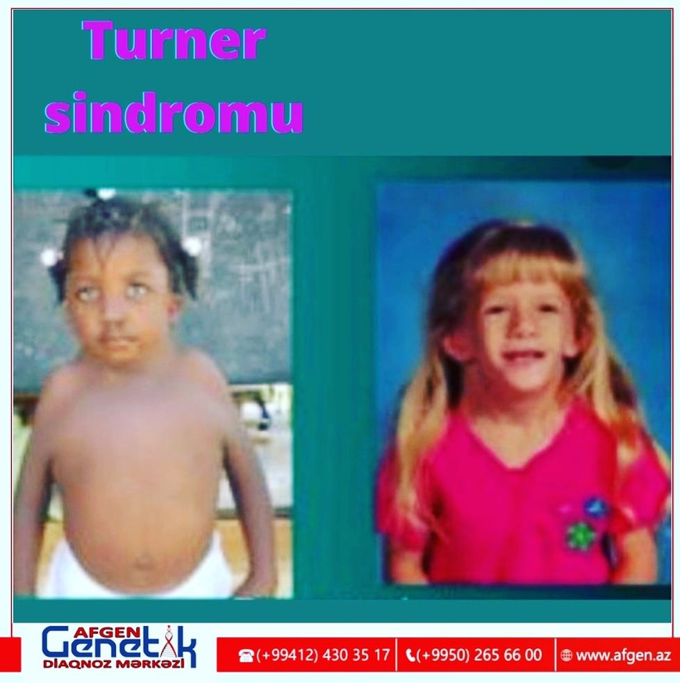 Təkcə qadınlarda görülən  Tuner sindromu 