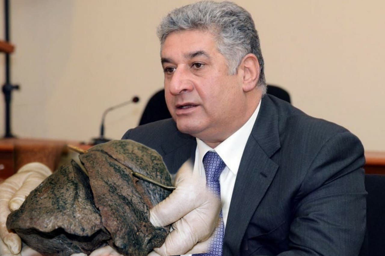 Azad Rəhimovda da aşkarlanan ən aqressiv xəstəlik -  Ağciyər xərçənginin ƏLAMƏTLƏRİ