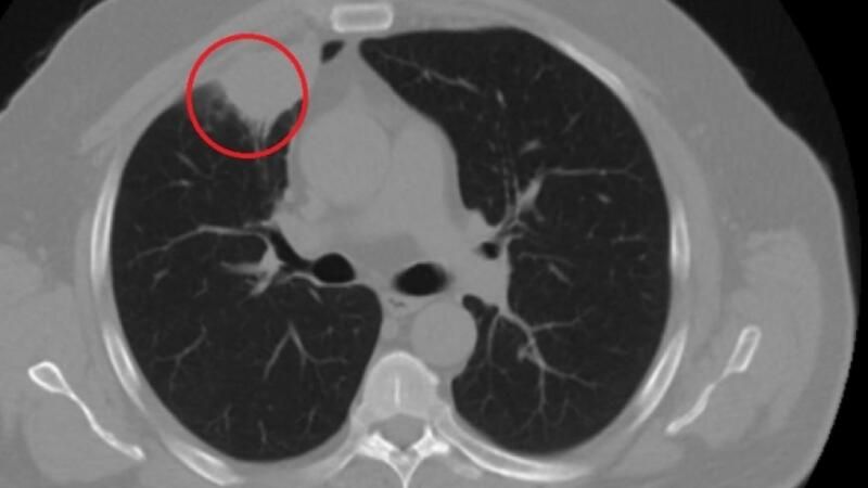 Koronavirus xəstəsinin ağciyərində xərçəngə bənzər şiş yaranıb 