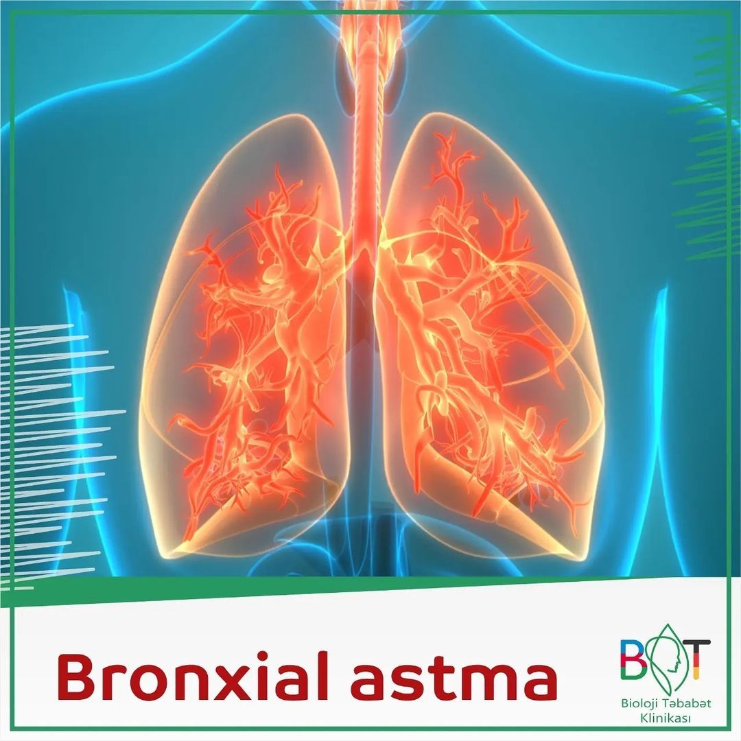 Bronxial astma necə və niyə yaranır?  